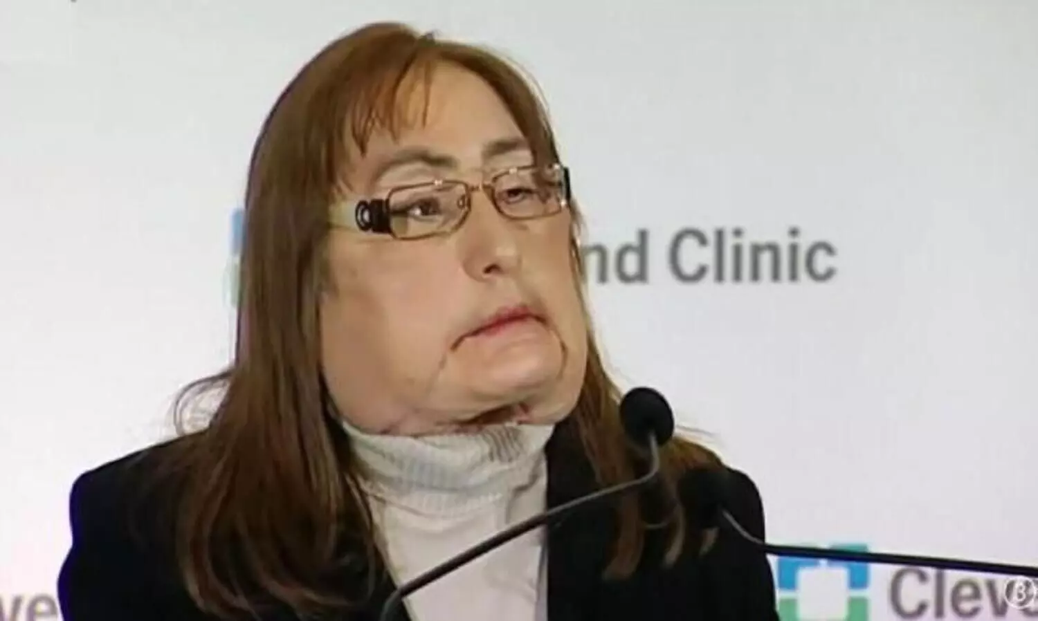 യു.എസിലെ ആദ്യ ഭാഗിക മുഖംമാറ്റിവെക്കല്‍ ശസ്ത്രക്രിയക്ക് വിധേയയായ സ്ത്രീ മരിച്ചു