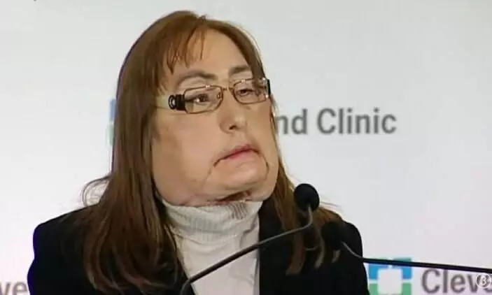 യു.എസിലെ ആദ്യ ഭാഗിക മുഖംമാറ്റിവെക്കല് ശസ്ത്രക്രിയക്ക് വിധേയയായ സ്ത്രീ മരിച്ചു യു.എസിലെ ആദ്യ ഭാഗിക മുഖംമാറ്റിവെക്കല് ശസ്ത്രക്രിയക്ക് വിധേയയായ സ്ത്രീ മരിച്ചു