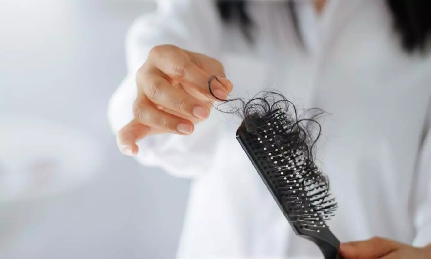 കോവിഡ് ഭേദമായവരില്‍ മുടികൊഴിച്ചില്‍ വ്യാപകമെന്ന്