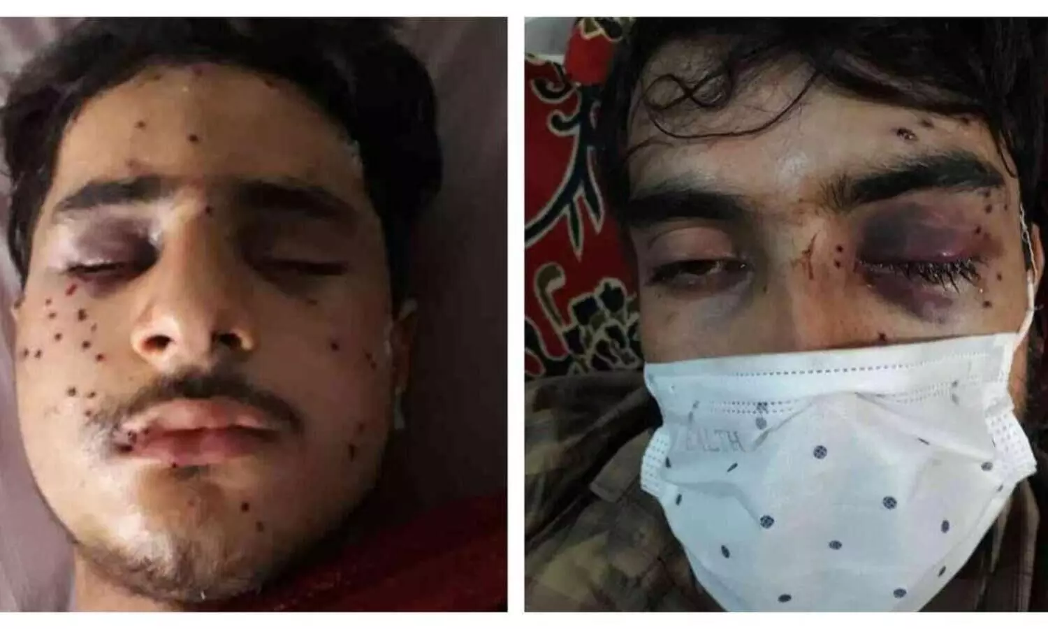 കോവിഡ്​ പ്രോ​ട്ടോകോൾ പാലിച്ചാണ്​ റാലി നീങ്ങിയത്​; പക്ഷേ എ​െൻറ കണ്ണുകൾ അവർ തകർത്തു - മുഹറം ദിനത്തിലെ പെല്ലറ്റ്​ ആക്രമണത്തിൽ കാഴ്​ച നഷ്​ടപെട്ട കശ്​മീർ യുവാവ്​ സങ്കട​ത്തോടെ പറയുന്നു