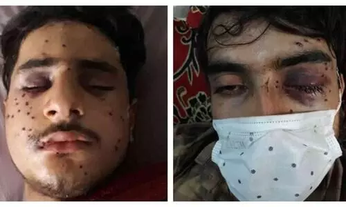 കോവിഡ്​ പ്രോ​ട്ടോകോൾ പാലിച്ചാണ്​ റാലി നീങ്ങിയത്​; പക്ഷേ എ​െൻറ കണ്ണുകൾ അവർ തകർത്തു - മുഹറം ദിനത്തിലെ പെല്ലറ്റ്​ ആക്രമണത്തിൽ കാഴ്​ച നഷ്​ടപെട്ട കശ്​മീർ യുവാവ്​ സങ്കട​ത്തോടെ പറയുന്നു