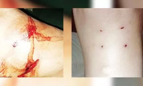 ഇരുവഴിഞ്ഞിപ്പുഴയിൽ നീർനായ്​ കടിച്ച്​ മൂന്നുപേർക്ക് പരിക്ക്​