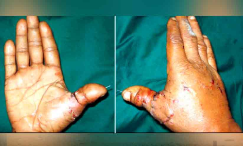 ശ​സ്ത്ര​ക്രി​യ വി​ജ​യം; അ​റ്റു​പോ​യ വി​ര​ൽ ഇ​നി​യും ച​ലി​ക്കും