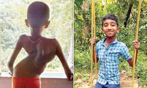 ഇന്ന്​ ലോക ന​െട്ടല്ല്​ ദിനം; ജോയ്​സ്​ ഇനി നിവർന്നു നിന്ന്​ ജീവിക്കും