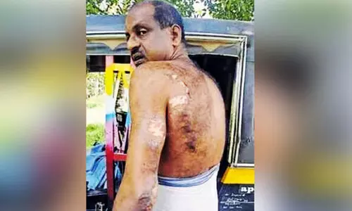 തലയിണക്കടിയിൽവെച്ച മൊബൈൽ ഫോൺ കത്തി ഒാേട്ടാ ഡ്രൈവർക്ക് പൊള്ളലേറ്റു