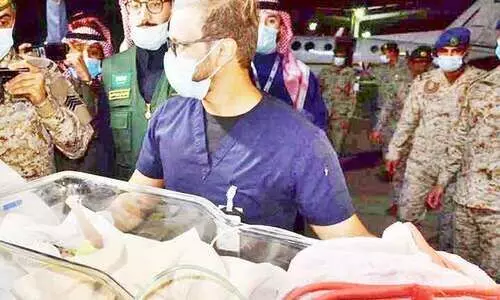 വേ​ർ​പെ​ടു​ത്ത​ൽ ശ​സ്​​ത്ര​ക്രി​യ:  യമൻ സയാമീസ്​ ഇരട്ടകളെ റിയാദിലെത്തിച്ചു