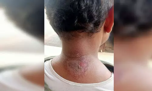 ജോലിക്കിടെ യുവാവിന്​ സൂര്യാതപമേറ്റു