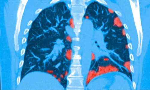 കൊറോണ വൈറസ്​ ശ്വാസകോശത്തെ പൊളിച്ചടുക്കുമെന്ന്​ കണ്ടെത്തൽ