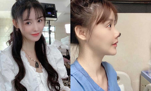 ഇനിയാരും സൗന്ദര്യവർധക ശസ്ത്രക്രിയ ചെയ്യല്ലേ...! ഞെട്ടിക്കുന്ന ചിത്രങ്ങൾ പങ്കുവെച്ച്​ നടി