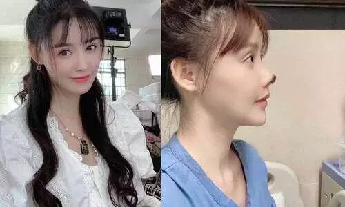 ഇനിയാരും സൗന്ദര്യവർധക ശസ്ത്രക്രിയ ചെയ്യല്ലേ...! ഞെട്ടിക്കുന്ന ചിത്രങ്ങൾ പങ്കുവെച്ച്​ നടി