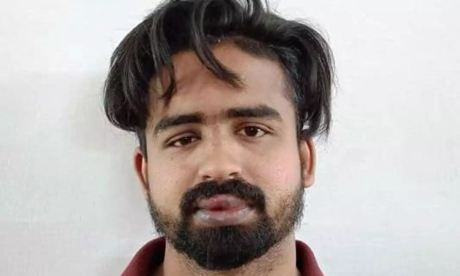 ബാറിലുണ്ടായ അടിപിടിക്കൊടുവിൽ മധ്യവയസ്​കന്‍റെ ജനനേന്ദ്രിയം കടിച്ചെടുത്തു