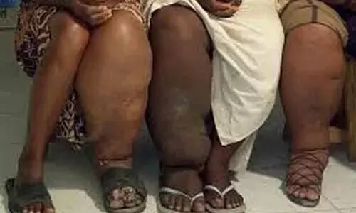 filariasis in kannur