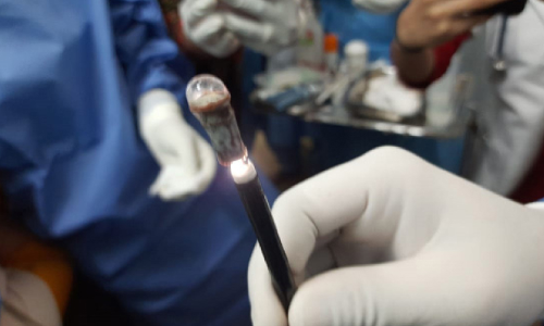 25 വ​ര്‍ഷം​മു​മ്പ് ക​ളി​ക്കു​ന്ന​തി​നി​ടെ വി​ഴു​ങ്ങി​യ വി​സി​ല്‍ നാ​ൽ​പ​താ​മ​ത്തെ വ​യ​സ്സി​ല്‍ പു​റ​ത്തെ​ടു​ത്തു