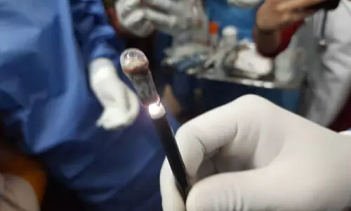 25 വര്ഷംമുമ്പ് കളിക്കുന്നതിനിടെ വിഴുങ്ങിയ വിസില് നാൽപതാമത്തെ വയസ്സില് പുറത്തെടുത്തു 25 വര്ഷംമുമ്പ് കളിക്കുന്നതിനിടെ വിഴുങ്ങിയ വിസില് നാൽപതാമത്തെ വയസ്സില് പുറത്തെടുത്തു