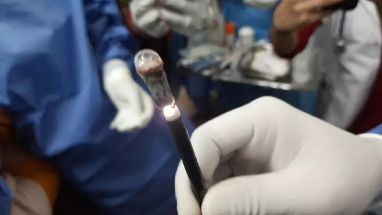 25 വര്ഷംമുമ്പ് കളിക്കുന്നതിനിടെ വിഴുങ്ങിയ വിസില് നാൽപതാമത്തെ വയസ്സില് പുറത്തെടുത്തു 25 വര്ഷംമുമ്പ് കളിക്കുന്നതിനിടെ വിഴുങ്ങിയ വിസില് നാൽപതാമത്തെ വയസ്സില് പുറത്തെടുത്തു