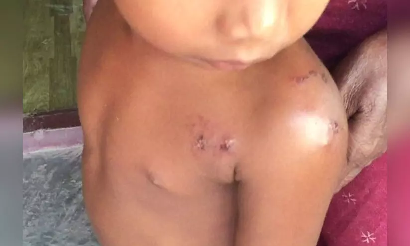 child attacked by street dog