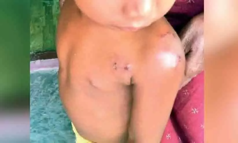 Street dog attack: Three-year-old girl injured