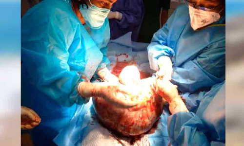 രോഗിയുടെ വയറ്റിൽനിന്ന്​ പത്തു കിലോ ഭാരമുള്ള മുഴ നീക്കി