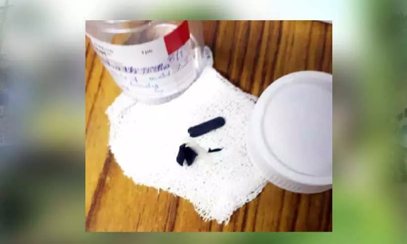 എട്ടുവയസ്സുകാരിയുടെ ശ്വാസനാളിയിൽ ഒ​രു മാ​സ​ത്തി​ലേ​റെ​ കുടുങ്ങിയ വിസിൽ പുറത്തെടുത്തു