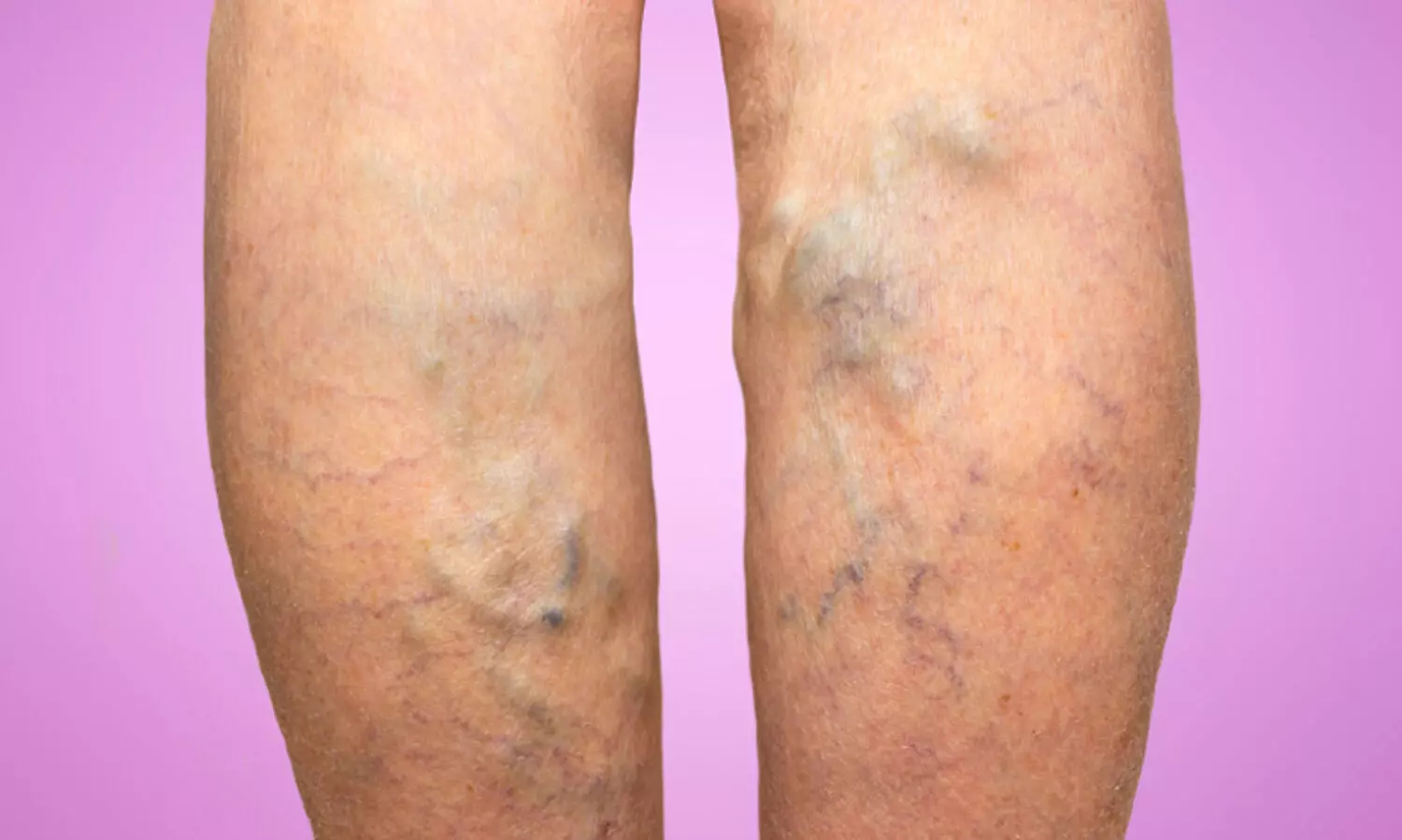 രക്തക്കുഴലുകൾ വീർത്ത്​ ചുരുളു​േമ്പാൾ