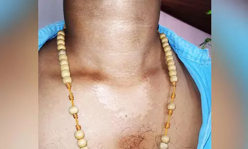 സൂ​ര്യാ​ത​പം: ര​ണ്ടു​പേ​ർ​ക്ക് പൊ​ള്ള​​ലേ​റ്റു