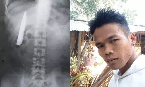 knife was stuck in a man chest for over a year after getting stabbed