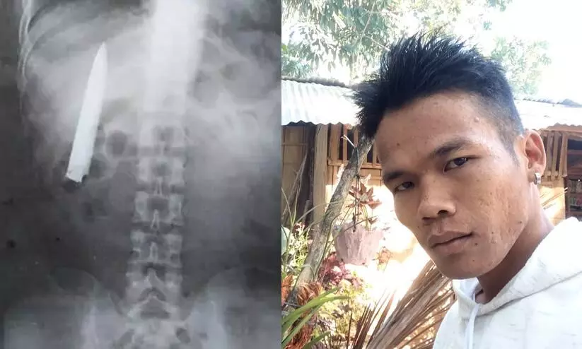 knife was stuck in a man chest for over a year after getting stabbed knife was stuck in a man chest for over a year after getting stabbed