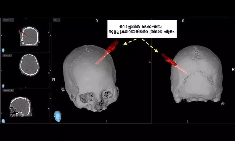 തലച്ചോറിൽ മരക്കഷണം തുളച്ചുകയറിയ 40കാരന്​ ഇത്​ പുനർജന്മം!