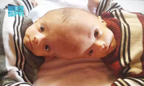 യമൻ സ​യാ​മീ​സ്​ ഇ​ര​ട്ട​ക​ൾ യൂ​സു​ഫി​നെ​യും യാ​സീ​നെ​യും റി​യാ​ദി​ലെ​ത്തി​ക്കും