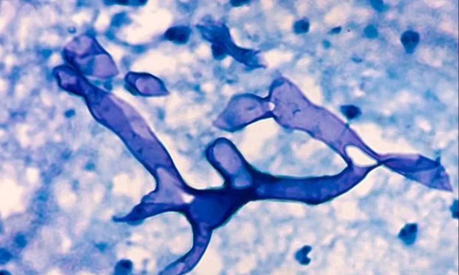 Mucormycosis black fungus