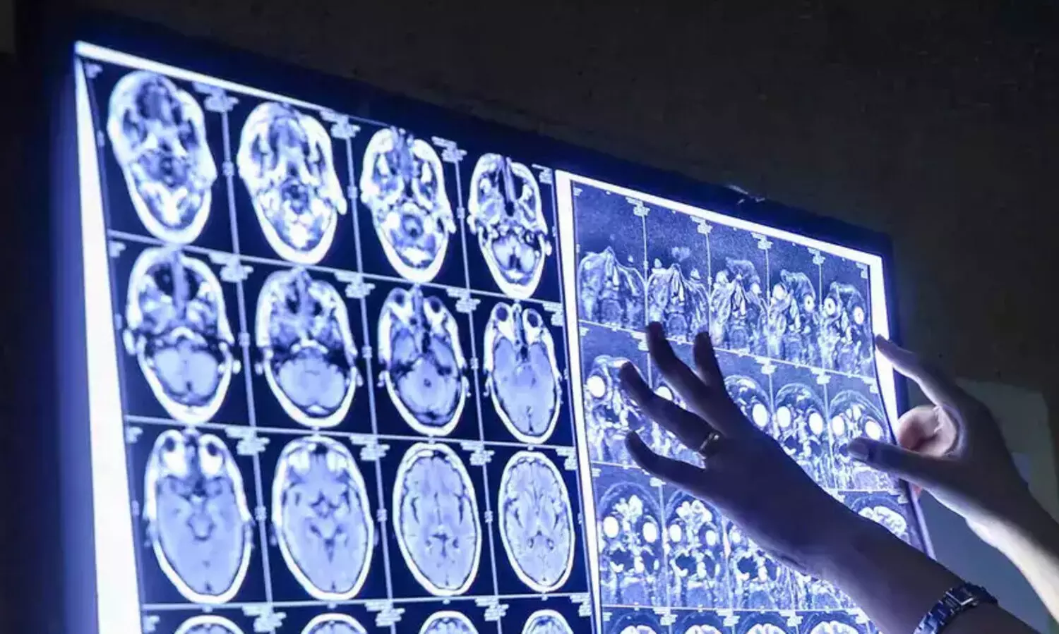 ബ്ലാക്​ ഫംഗസ്​ ബാധയിൽ കൂടുതൽ സംസ്​ഥാനങ്ങൾ