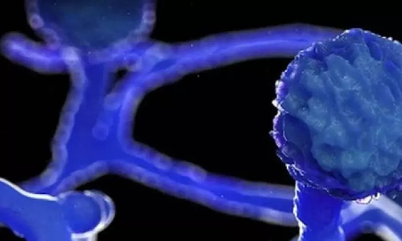 കർണാടകയിൽ ബ്ലാക്ക് ഫംഗസും പിടിമുറുക്കുന്നു; ചികിത്സ കിട്ടാതെ രോഗികൾ വലയുന്നു കർണാടകയിൽ ബ്ലാക്ക് ഫംഗസും പിടിമുറുക്കുന്നു; ചികിത്സ കിട്ടാതെ രോഗികൾ വലയുന്നു