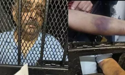 കണ്ണിനും കൈക്കും പരിക്ക്​​; ജയിലിൽ നിന്നുള്ള മെഹുൽ ചോക്​സിയുടെ ചിത്രങ്ങൾ പുറത്ത്​