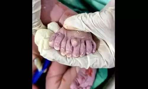 ഇടതുകാലില് ഒന്പത് വിരലുകളുമായി ആണ്കുഞ്ഞ് ജനിച്ചു: ഇത്, ദൈവത്തിന്െറ വരദാനമെന്ന് കുടുംബം ഇടതുകാലില് ഒന്പത് വിരലുകളുമായി ആണ്കുഞ്ഞ് ജനിച്ചു: ഇത്, ദൈവത്തിന്െറ വരദാനമെന്ന് കുടുംബം