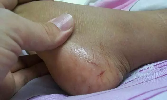 snake bite snake bite