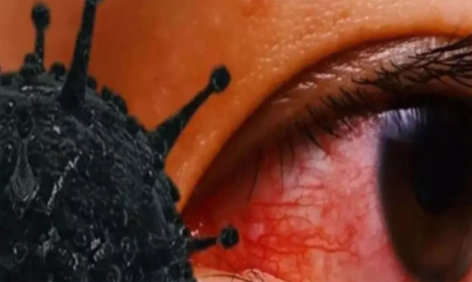 മുംബൈയില്‍ മൂന്നുകുട്ടികളുടെ കണ്ണ് നീക്കം ചെയ്തു; കുട്ടികളിലെ ബ്ലാക്ക് ഫംഗസ് ബാധ ആശങ്കയുയർത്തുന്നു