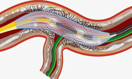 Intravascular lithotripsy