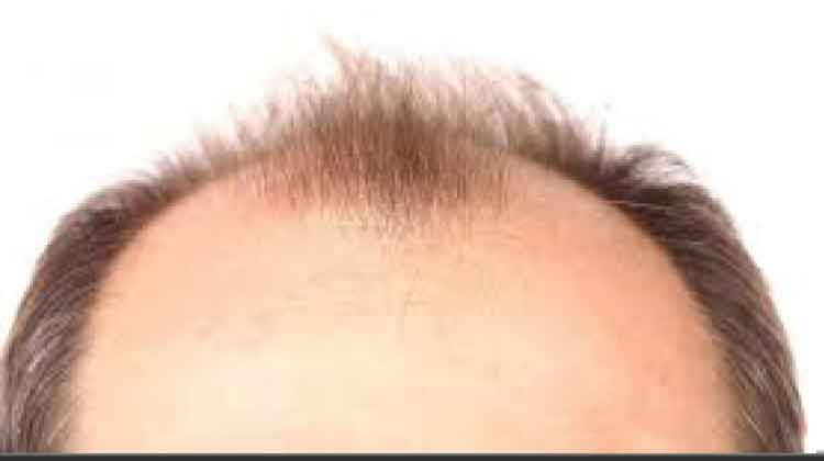 കഷണ്ടിക്കും കുടവയറിനും മരുന്ന്: വലവിരിച്ച് തട്ടിപ്പുകാർ കഷണ്ടിക്കും കുടവയറിനും മരുന്ന്: വലവിരിച്ച് തട്ടിപ്പുകാർ