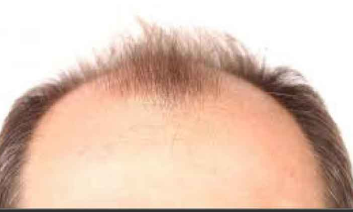 കഷണ്ടിക്കും കുടവയറിനും മരുന്ന്: വലവിരിച്ച് തട്ടിപ്പുകാർ