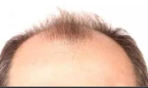 കഷണ്ടിക്കും കുടവയറിനും മരുന്ന്: വലവിരിച്ച് തട്ടിപ്പുകാർ