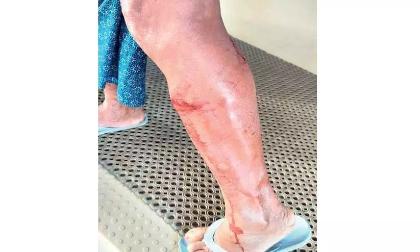 മഞ്ചേരിയിൽ ആറുപേർക്ക് തെരുവുനായുടെ കടിയേറ്റു മഞ്ചേരിയിൽ ആറുപേർക്ക് തെരുവുനായുടെ കടിയേറ്റു