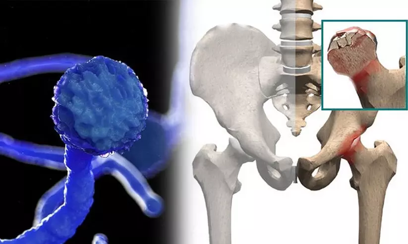 കോവിഡ് ഭേദമായവരിൽ അസ്ഥി മരണം; ബ്ലാക്ക് ഫംഗസിന് പിന്നാലെ പുതിയ വെല്ലുവിളി, മുംബൈയിൽ മൂന്നു പേർ ചികിത്സ തേടി കോവിഡ് ഭേദമായവരിൽ അസ്ഥി മരണം; ബ്ലാക്ക് ഫംഗസിന് പിന്നാലെ പുതിയ വെല്ലുവിളി, മുംബൈയിൽ മൂന്നു പേർ ചികിത്സ തേടി