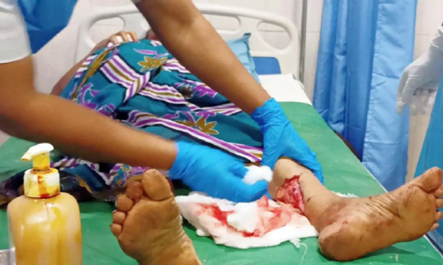 പേപ്പട്ടിയുടെ കടിയേറ്റ് നിരവധി പേർക്ക് പരിക്ക്