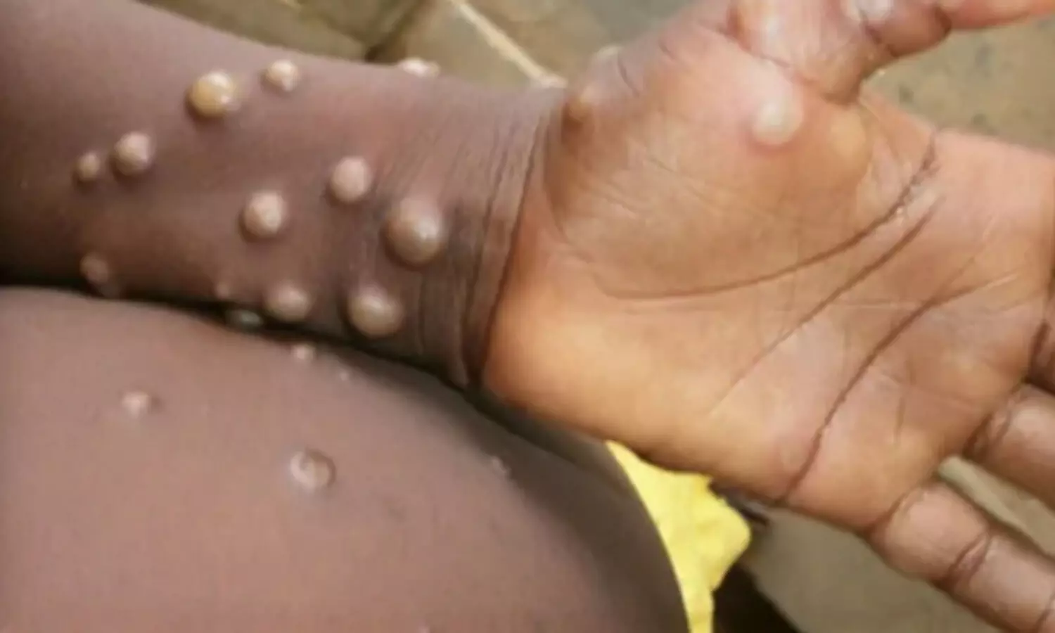 കുരങ്ങുപനി: മുംബൈയിൽ ഐസൊലേഷൻ വാർഡൊരുക്കി