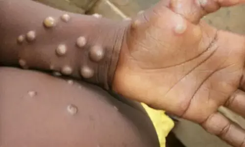 കുരങ്ങുപനി: മുംബൈയിൽ ഐസൊലേഷൻ വാർഡൊരുക്കി