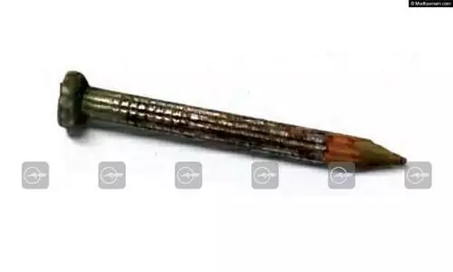 ഒ​ന്ന​ര വ​യ​സ്സു​കാ​ര​ൻ ഇരുമ്പാണി വി​ഴു​ങ്ങി; അതിസ​ങ്കീ​ര്‍ണ​മാ​യ ശ​സ്ത്ര​ക്രി​യയിലുടെ  ഒടുവിൽ പുറത്തെടുത്ത്​