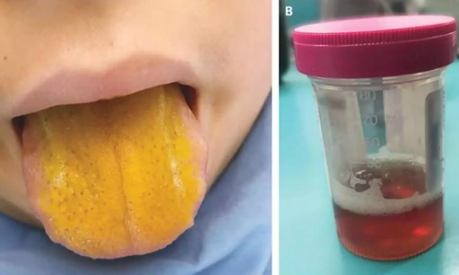 yellow tongue and dark urine
