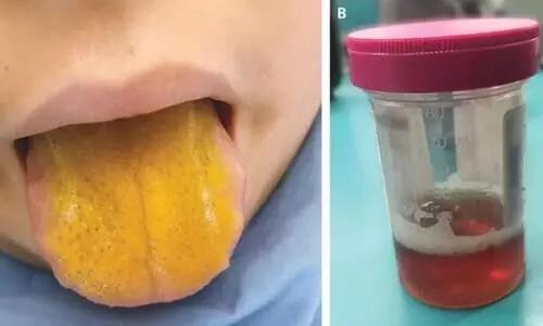 yellow tongue and dark urine