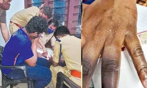 ഒടുവിൽ ആ മോതിരം മുറിച്ചു; അനുദിന് ആശ്വാസം