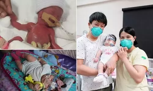 Worlds Smallest BabyGoes Home After 13 Months In Hospital